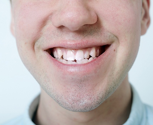 A close-up of a teen with misaligned teeth 