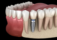 Animated rendering of implant supported dental crown