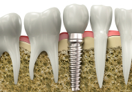 Animation of implant replacement tooth in grafted bone