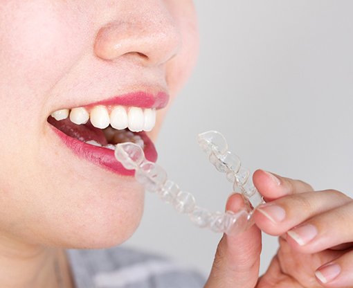 woman taking out Invisalign 