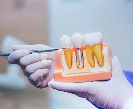 Dentist pointing to a dental implant model