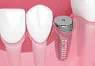 Digital illustration of a dental implant