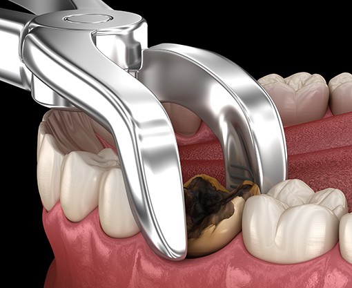 Illustration of tooth extraction