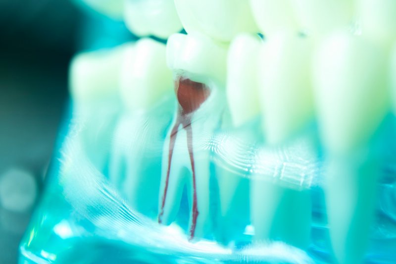 Illustration of root canal