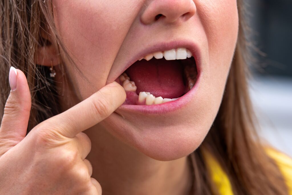 Nose-to-neck view of woman pulling lip aside to reveal missing tooth